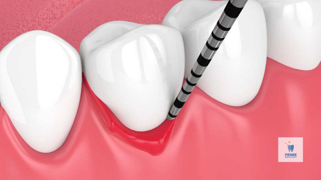 Close-up of dental probe examining gum health, showing gingivitis