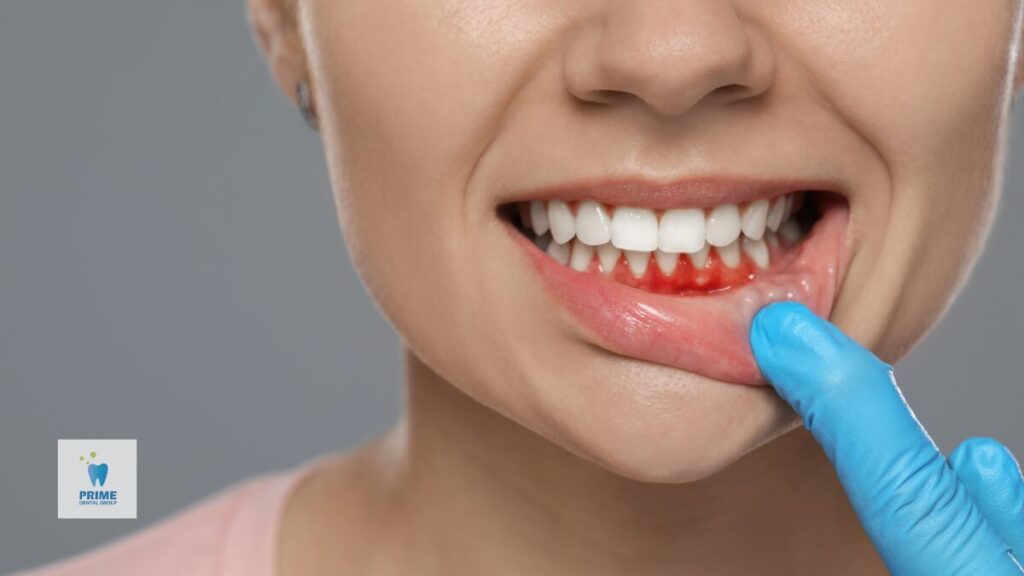 Close-up of woman showing red, inflamed gums indicating gingivitis.