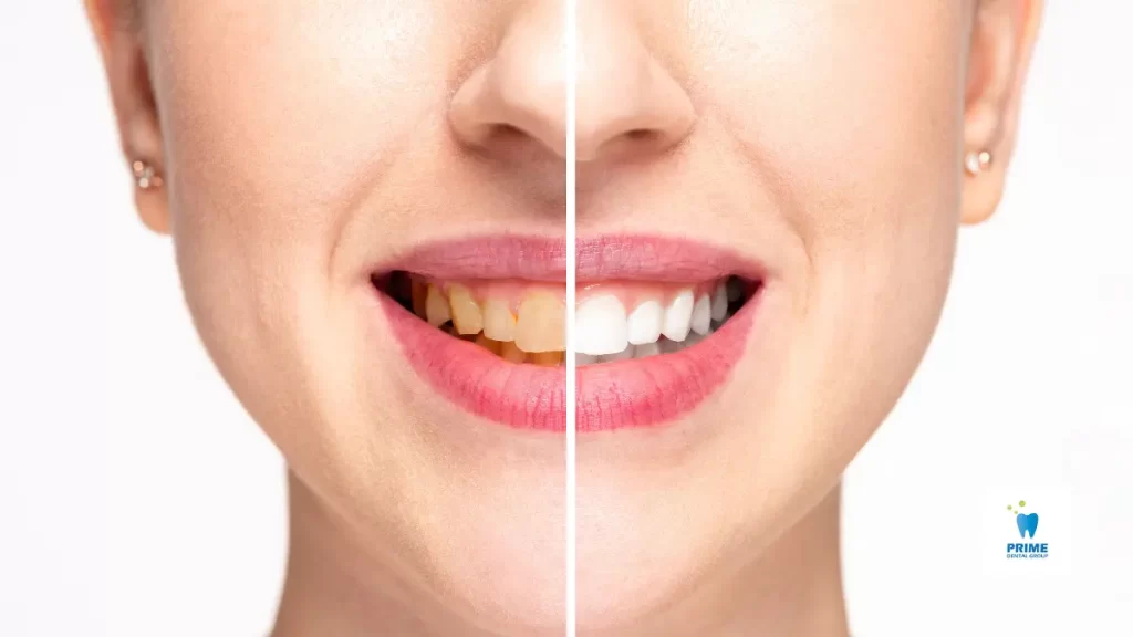 Close-up of a smiling face with a split view showing yellowed teeth on the left and professionally whitened teeth on the right.