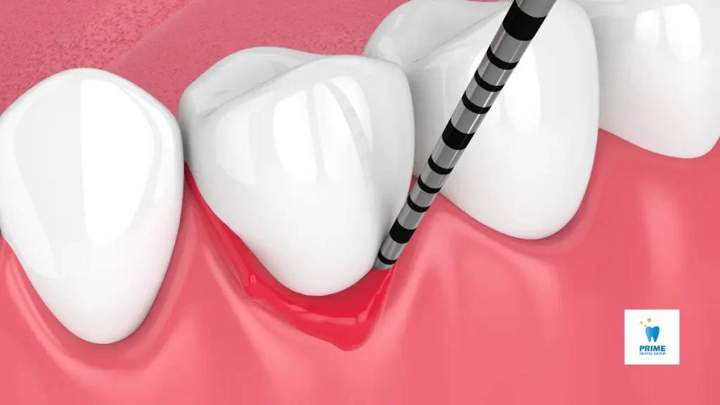 A 3D illustration of a periodontal probe measuring gum pocket depth, indicating potential gum disease.