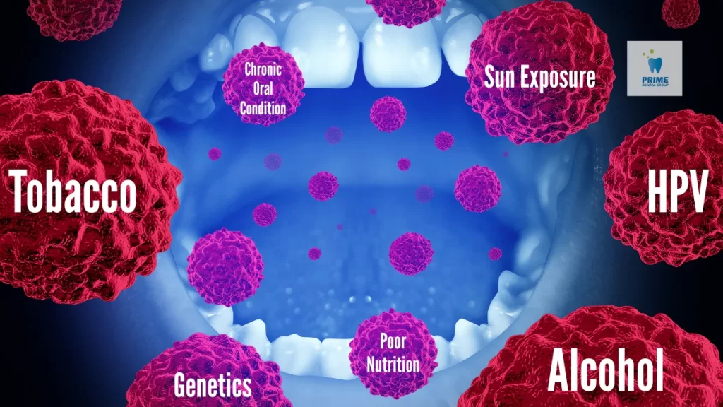 Illustration of oral cancer risk factors inside an open mouth, including tobacco, alcohol, HPV, and poor nutrition.